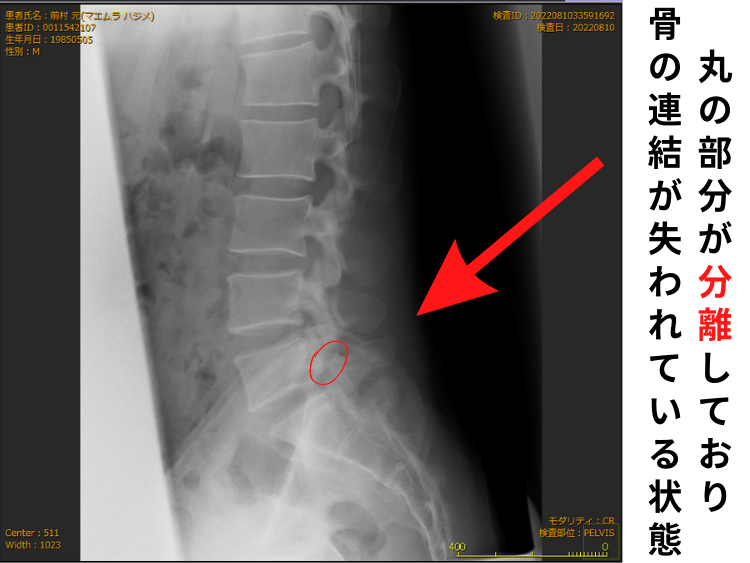 腰椎分離症 大津市南郷 あゆは整体院整骨院 院長自身も分離症